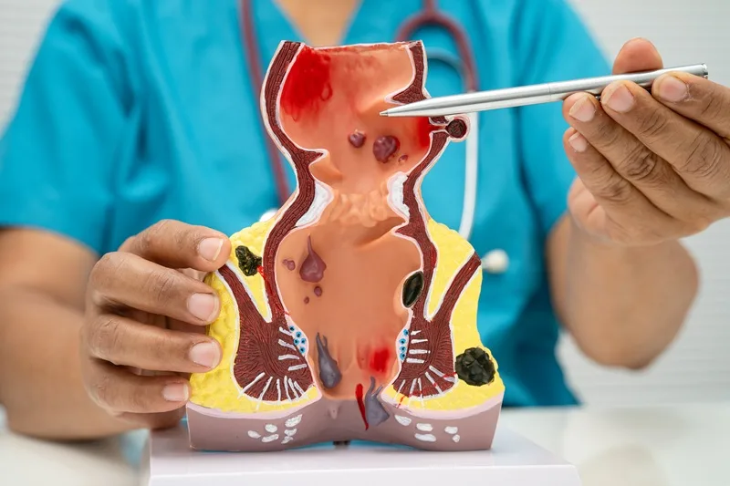 Cáncer de canal anal