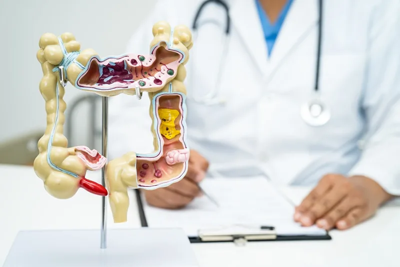 Cáncer de colon