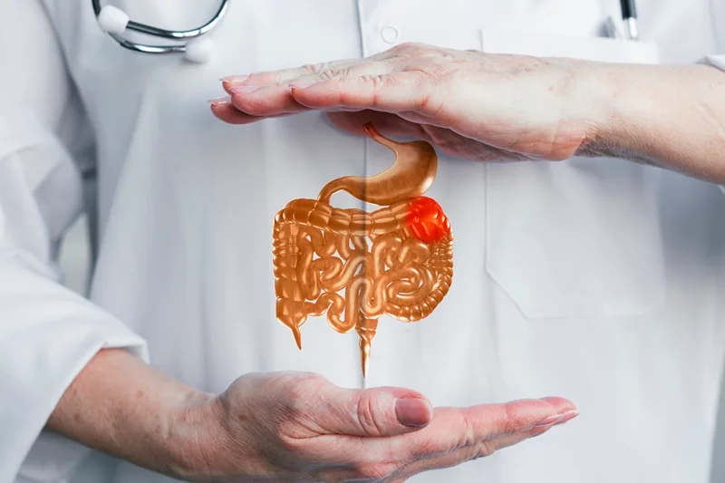 Cáncer de recto