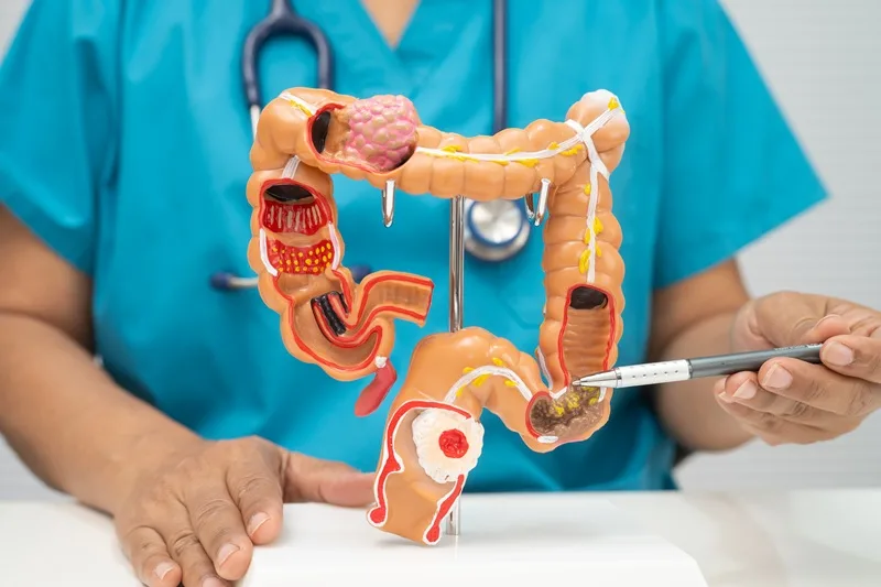 Cáncer de recto